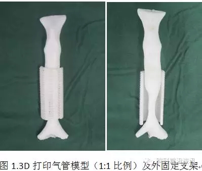 西安交大助力唐都医院成功完成首例气管3D打印外支架悬吊术